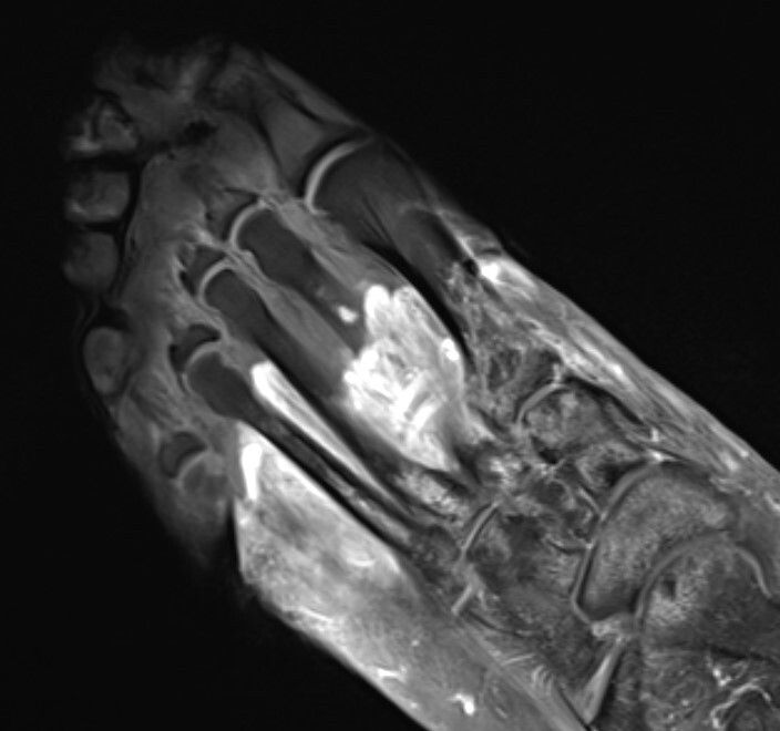 MRI of the foot in a patient with severe Covid-19. The grey part of the foot is devitalized tissue (gangrene).