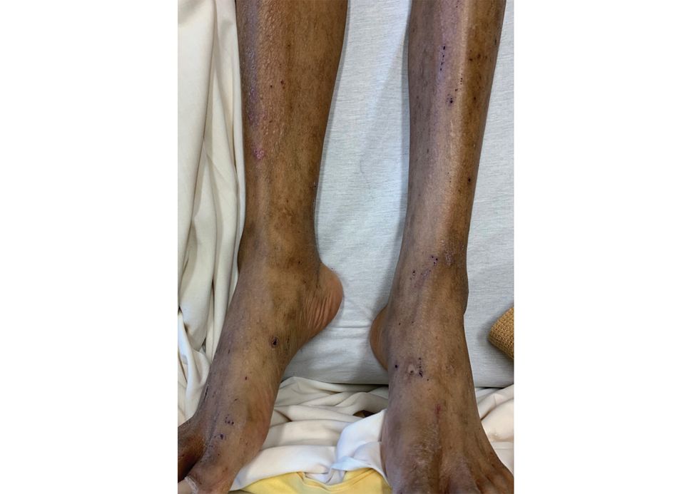 Lesions mark the legs of a 48-year-old Winnipeg man with endocarditis due to Bartonella quintana. The photo, supplied to the Canadian Medical Association Journal, shows that unlike bedbugs, body lice bites do not follow sock or belt lines where pressure is applied to the body.