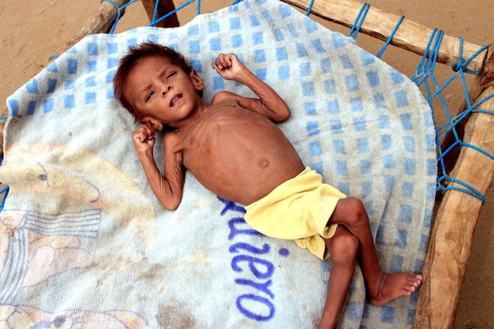 Meshaal Mohammad, 4, weighs just 20 pounds due to acute malnutrition. He is currently staying at a camp for the internally di