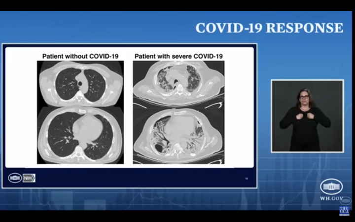 The lungs seen on the left belong to someone who is healthy, while the lungs on the right are from a COVID-19 patient. The black and dark areas seen in the lungs on the left are normal because they indicate air spaces, Dr. Anthony Fauci said.