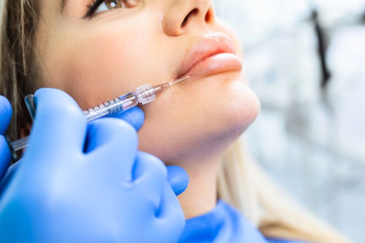 Excess lip filler can migrate around the lips if too much is injected.