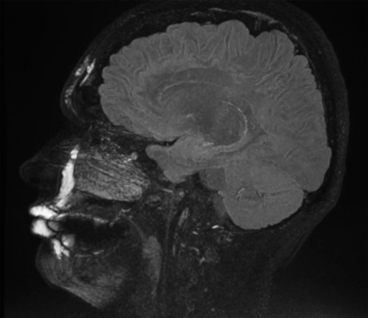 Yes, MRIs can show where filler has been injected in the face.