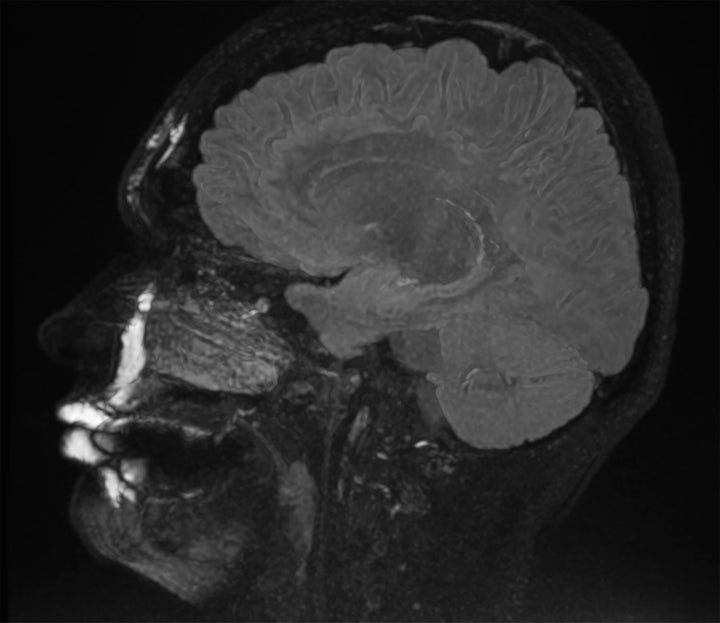 Yes, MRIs can show where filler has been injected in the face.