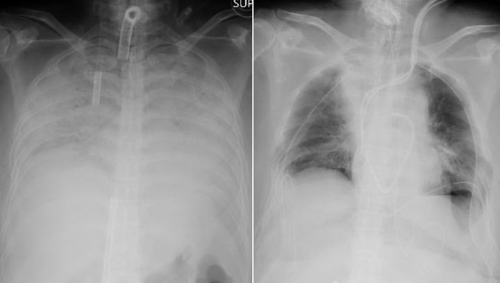 Η ακτινογραφία που έγινε στους πνεύμονες πριν και μετά (δεξιά). Οι σκοτεινές περιοχές δείχνουν που έγινε η μεταμόσχευση του πνευμονικού ιστού. 