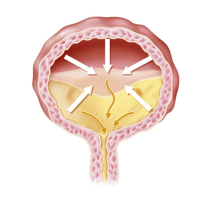 The detrusor muscle, seen here in the bladder's wall, contracts when it's time to urinate.