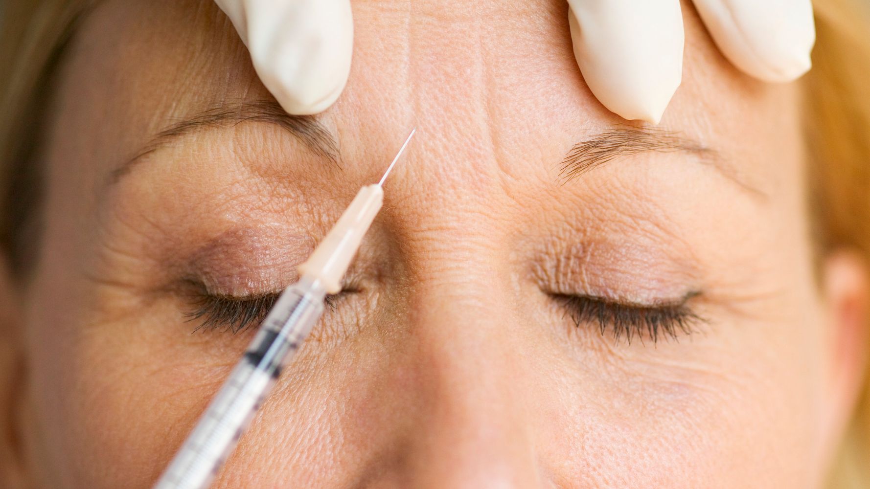 Should I Let My Botox Wear Off Completely?