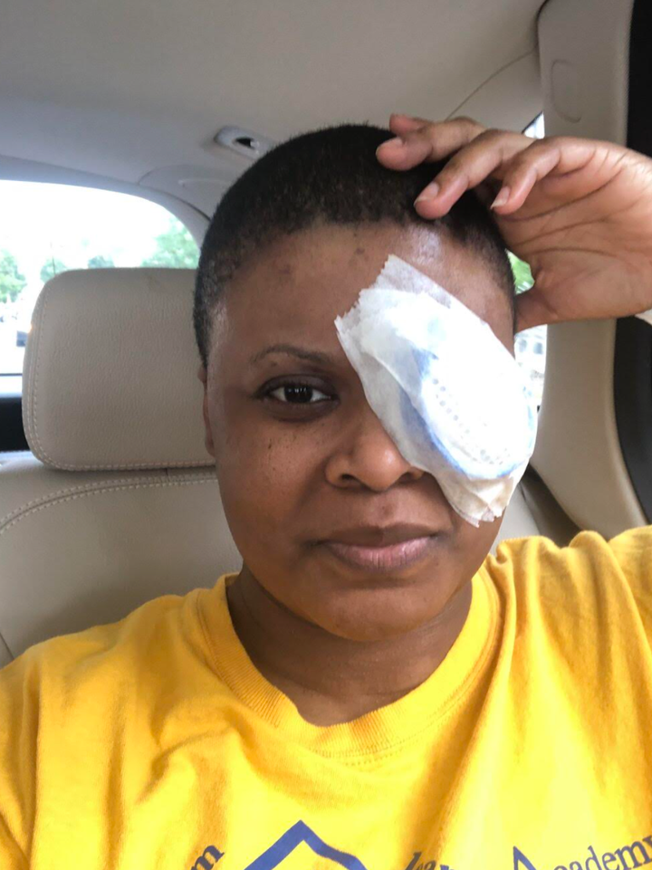 The author immediately following cataract surgery on Sept. 3, 2020. She developed a dense cataract following her COVID-19 infection.