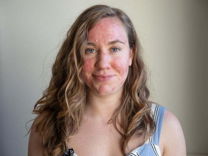 This is just one example of the many ways rosacea can display.
