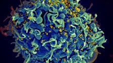 COVID-19 Pandemic Has Derailed Fight Against AIDS, UN Says COVID-19 Pandemic Has Derailed Fight Against AIDS, UN Says