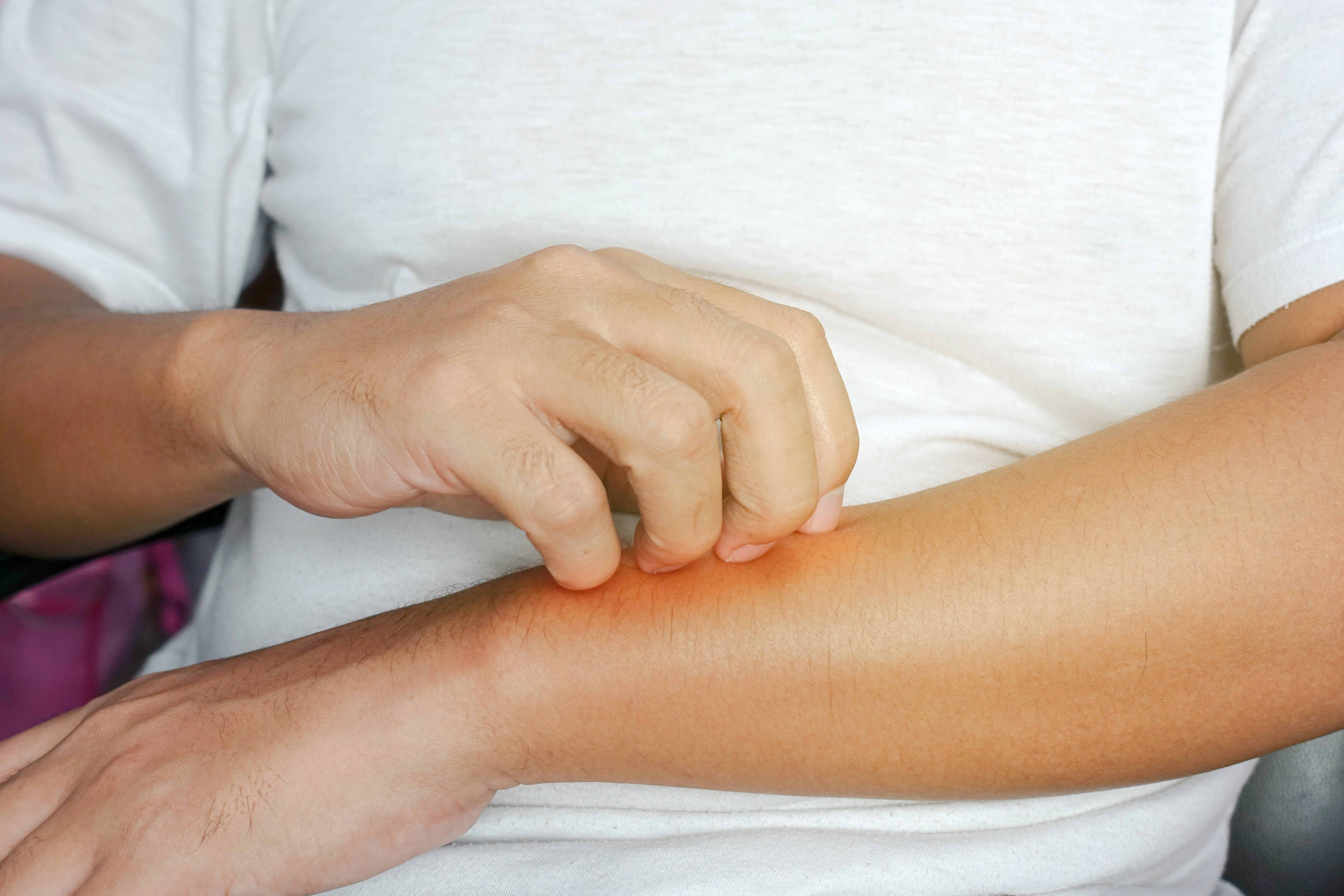 Revealed 5 Common Reasons For Itchy Skin In Summer HuffPost UK Life