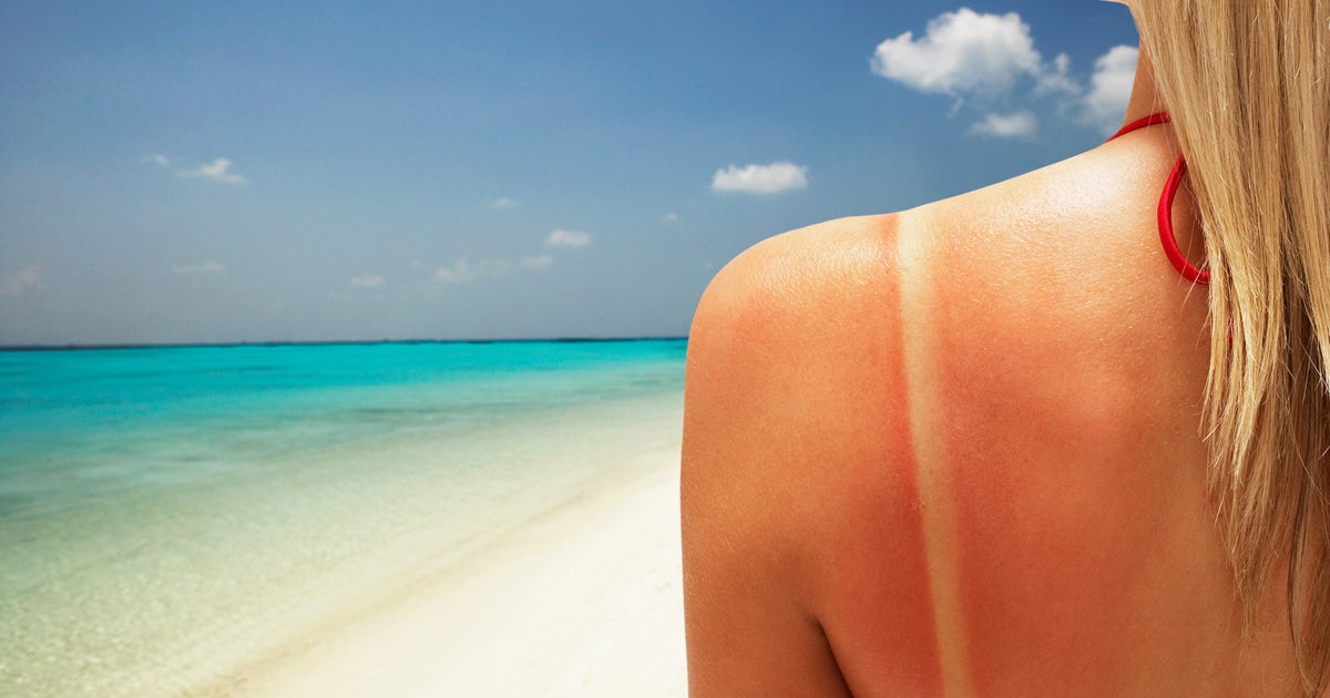 Think You Can’t Get Skin Cancer From Just One Sunburn? Think Again. Think You Can’t Get Skin Cancer From Just One Sunburn? Think Again.