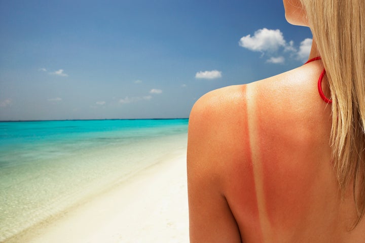 Can You Get Skin Cancer From Just One Sunburn?