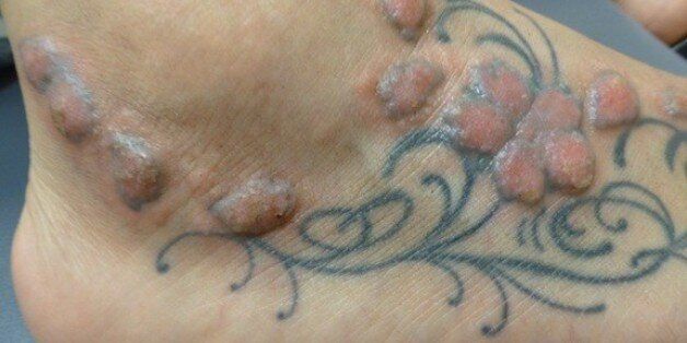 In Addition To Regret, Tattoos Can Pose Serious Health Risks | HuffPost  Latest News
