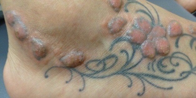 Tattoo regret: Can you make it go away?