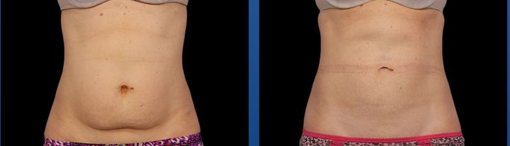 Before-and-after photos on the CoolSculpting site show a patient who's undergone two treatments on their abdomen.