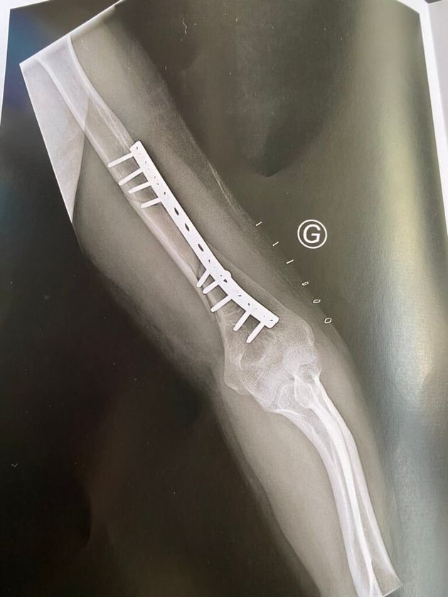 Un jeune homme de 26 ans a failli perdre son bras à cause d'un bras de fer