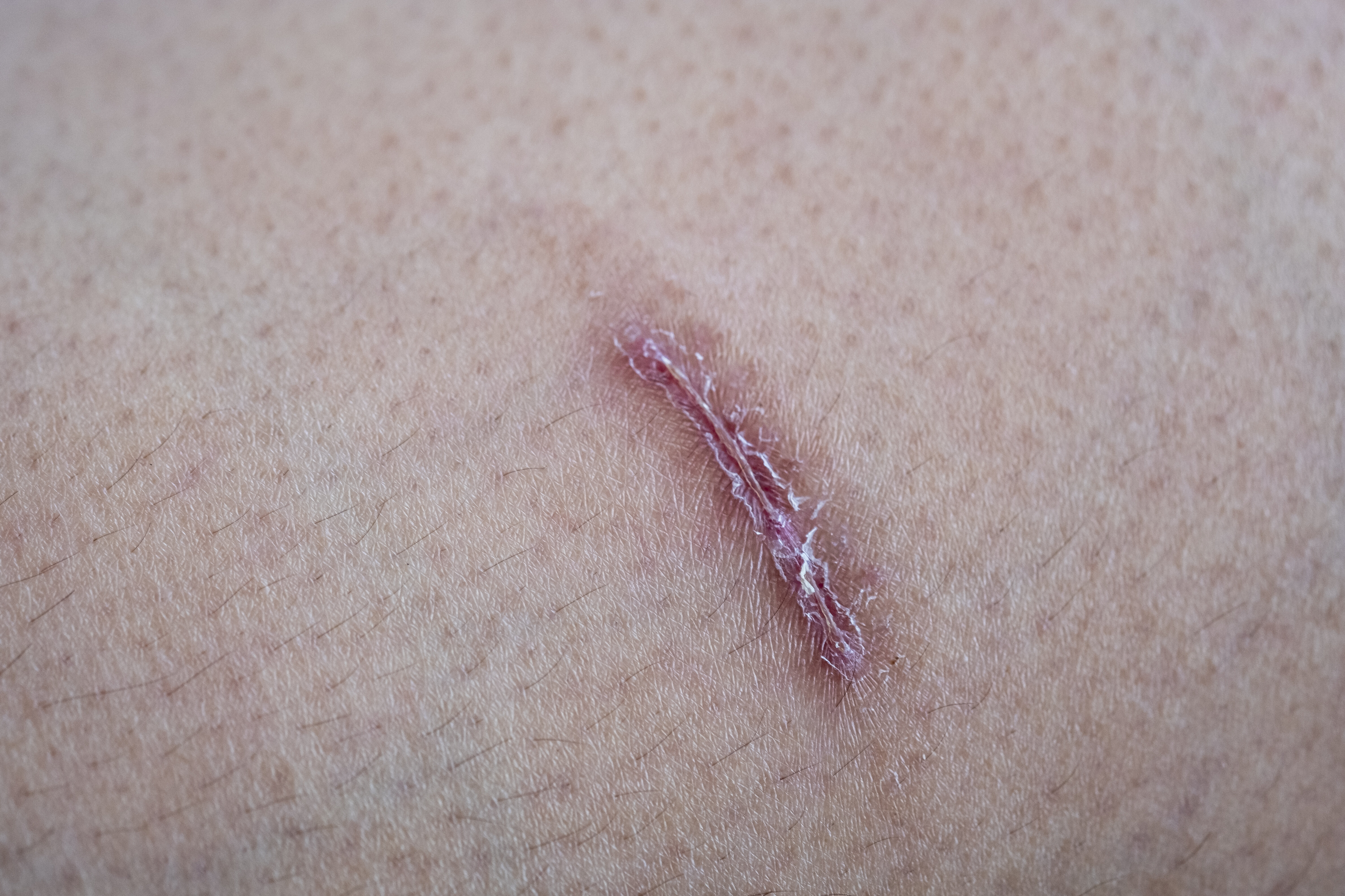 I Used To Cut Myself. Here’s What It’s Like To Live With The Scars ...