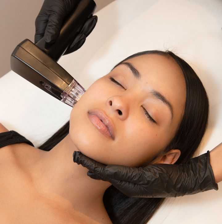 A patient undergoes remodeling, which combines microneedling and radiofrequency technology to tighten loose skin.