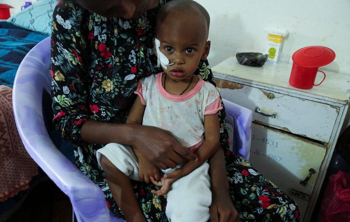 Ααμανουέλ Μερχάουι, 1 έτους και 8 μηνών. Υποφέρει από οξύ υποσιτισμό. Τιγκράι 11 Ιουλίου, 2021. 