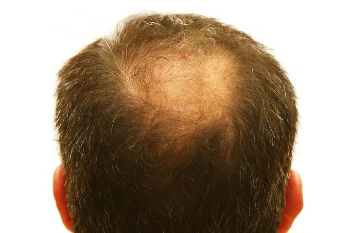 male head with hair loss...