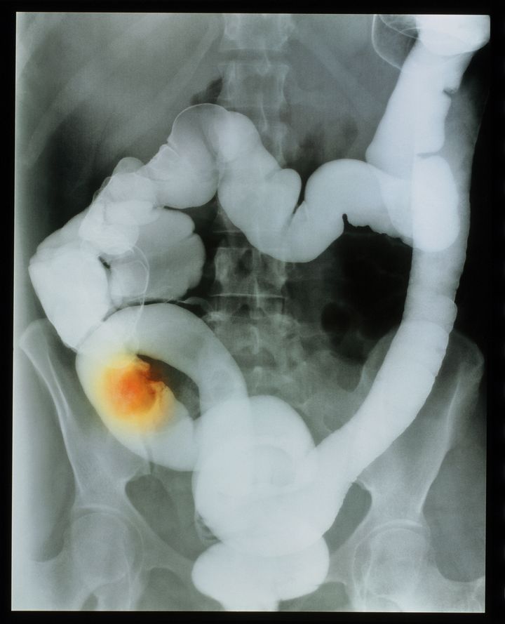 Cancer of the colon. Coloured barium enema X-ray of the human abdomen showing a cancer of the ascending colon; the tumour appears as the enhanced area over the right pelvic bone (left on image). Opaque to X- rays, barium is given orally (barium meal) for investigations of the oesophagus, stomach & duodenum and rectally (as a barium enema) to examine the rectum & colon. The colon (large intestine) consists of four sections sigmoid colons. Here, the ascending colon rises at left, its transverse (horizontal) section appears in centre, and the descending part at right.