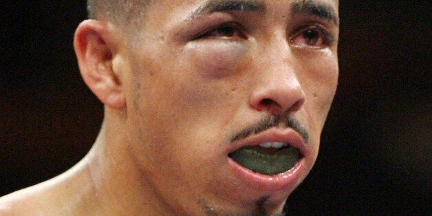 LAS VEGAS - JULY 26: Giovani Segura's eye starts to swell during his interim WBA light flyweight title fight against Cesar Canchila at the MGM Grand Garden Arena July 26, 2008 in Las Vegas, Nevada. Canchila won by unanimous decision. (Photo by Ethan Miller/Getty Images)