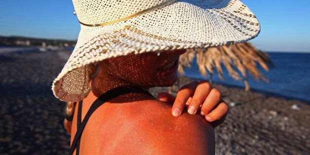 RHODES, GREECE - JULY 16: A woman on a beach with a sunburned back near Lindos on July 16, 2009 in Rhodes, Greece. Rhodes is the largest of the Greek Dodecanes Islands. (Photo by EyesWideOpen/Getty Images)