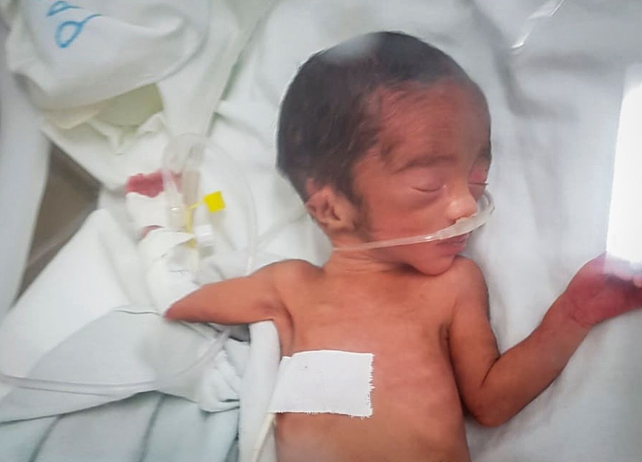 Σε αυτή τη φωτογραφία που παραχωρήθηκε ανώνυμα, ένα νεογέννητο μωρό που ζυγίζει μόλις 800 γραμμάρια, νοσηλεύεται σε κλινική. Λίγο μετά τη γέννησή του πέθανε μαζί με την υποσιτισμένη μητέρα του, Τρίτη 14 Σεπτεμβρίου 2021, στην περιοχή Τιγκρέι της βόρειας Αιθιοπίας. Εδώ και μήνες, τα Ηνωμένα Έθνη έχουν προειδοποιήσει για λιμό στο Τιγκράι και τώρα εσωτερικά έγγραφα και μαρτυρίες αποκαλύπτουν τους πρώτους θανάτους από λιμό από τότε που η κυβέρνηση της Αιθιοπίας επέβαλε τον Ιούνιο αυτό που ο ΟΗΕ αποκαλεί «de facto αποκλεισμό της ανθρωπιστικής βοήθειας». (UGC μέσω AP)