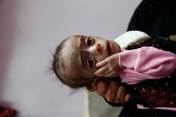 Ένα από τα χιλιάδες υποσιτισμένα παιδιά στην Υεμένη (Σαναά, 22/9/2021)