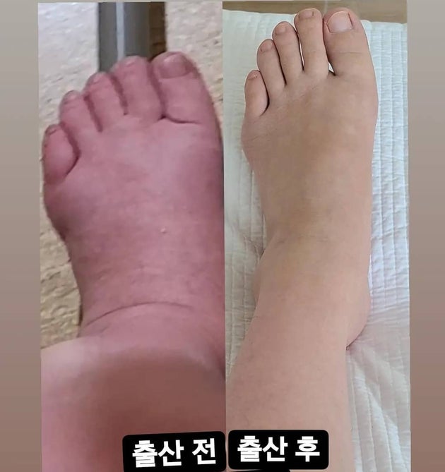 출산 전후로 달라진 황신영의 발 상태.