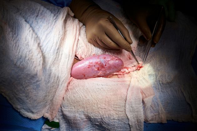 L'organe a été implanté à l'extérieur du corps pour permettre l'observation et l'échantillonnage des...