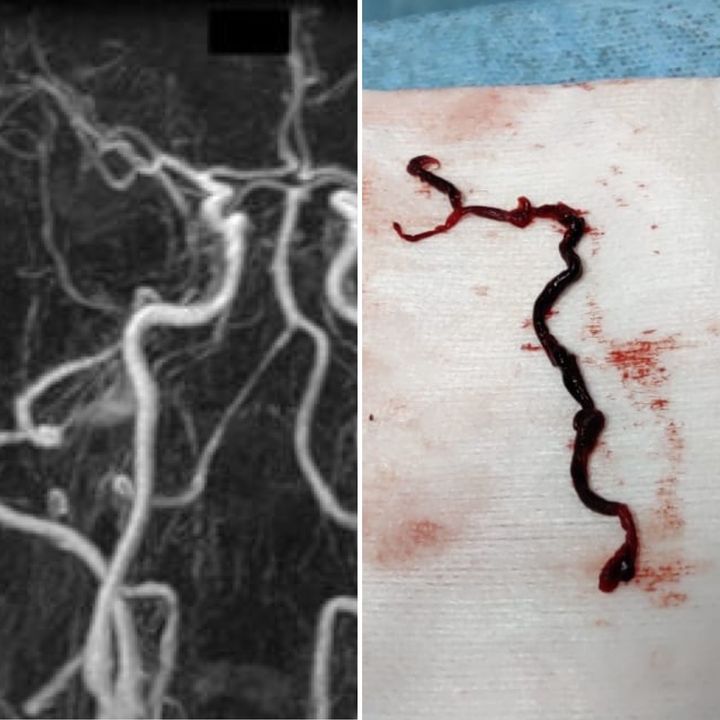 En la imagen de la derecha se ve un trombo que se ha sacado, que, como muestra la imagen de la izquierda, ocupaba toda la arteria.