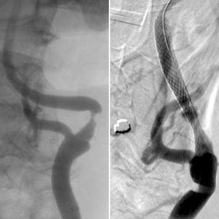 En la imagen de la izquierda se ve claramente el punto en el que la arteria está cerrada. Y en la imagen de la derecha se ve el muelle colocado que la abre.