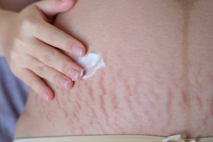 6 skin problems that can develop during pregnancy, Your Pregnancy Matters