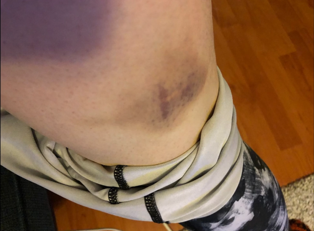 Η Πάρβιν τράβηξε φωτογραφίες από τους μώλωπες της που ισχυρίζεται ότι ήταν αποτέλεσμα της σύλληψης από...