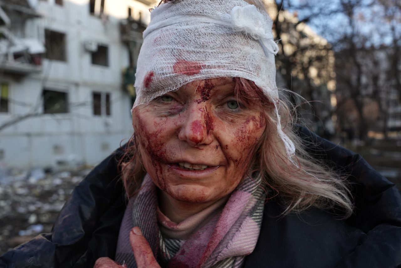 A woman who was wounded by an airstrike on an apartment complex outside of Kharkiv, Ukraine. 