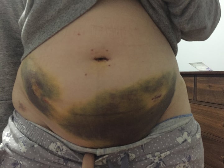 The author's abdomen, post-surgery.