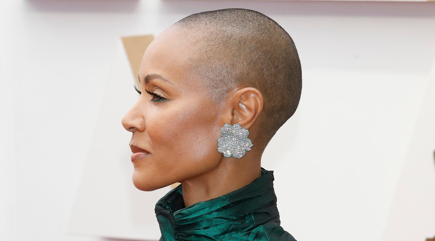 What You Need To Know About Alopecia