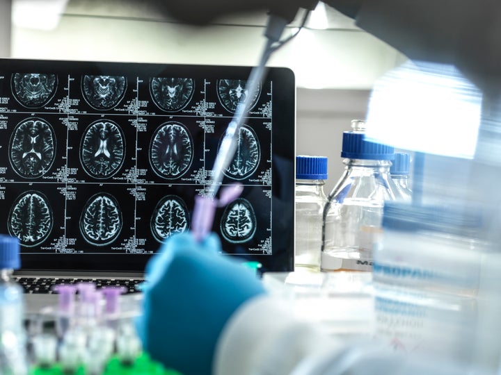 Investigación sobre el alzheimer.