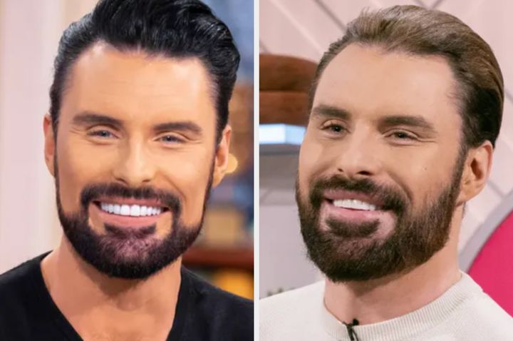 Rylan with his old veneers (left) and his newest set