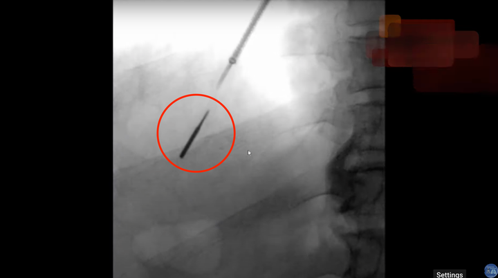 The drill bit Tom Jozsi accidentally inhaled during a routine dental procedure is seen deep in his lung.