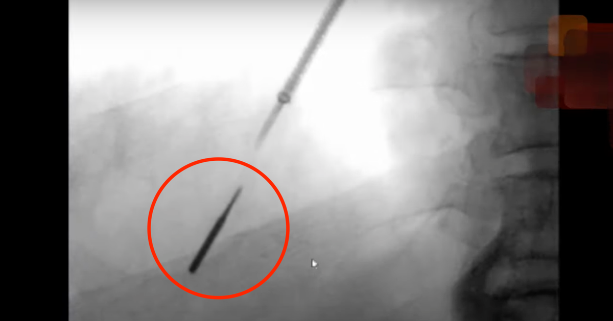 Man Accidentally Inhales Drill Bit During Dental Procedure HuffPost