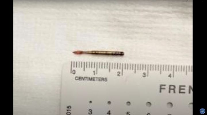 The drill bit is seen next to a ruler after being extracted from Jozsi's lung.