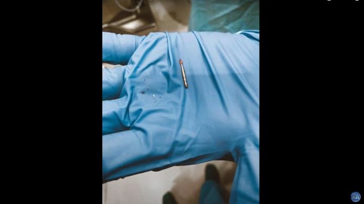 Dr. Alraiyes holds the bit in his hand after successfully extracting it from Jozsi’s lung.