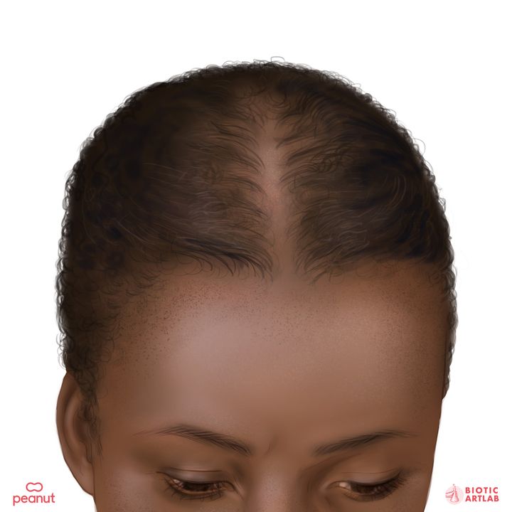 A Black woman with thinning hair.