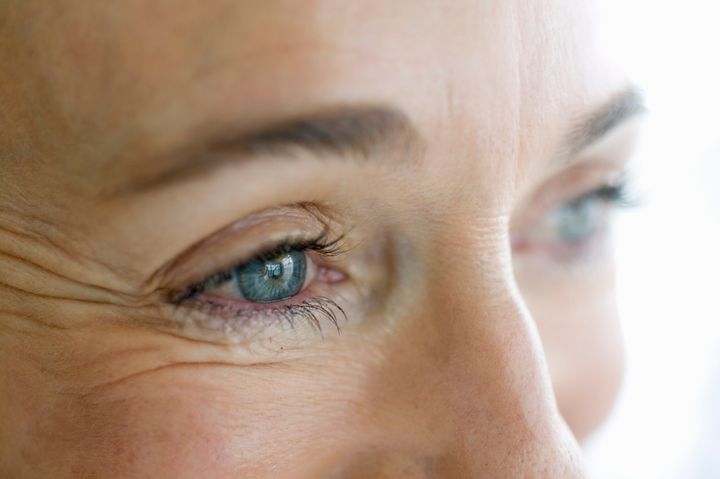 Best Ways To Treat And Prevent Fine Lines Around Your Eyes