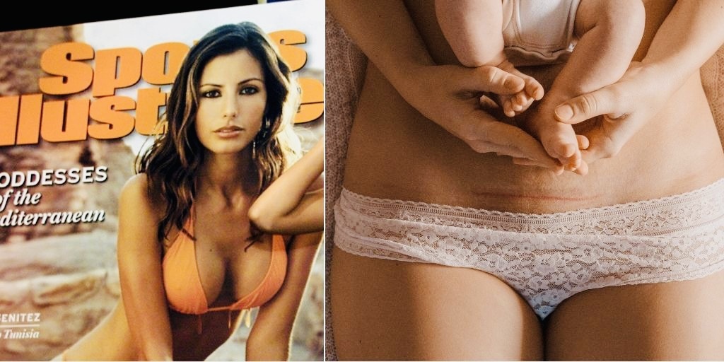 SI Swimsuit Features First Model With Visible C Section Scar And