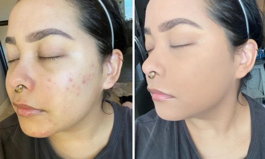 tend skin review before and after on neck｜TikTok Search
