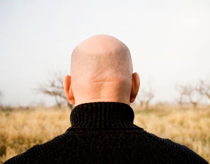 Should bald men have to put up with comments on their appearance from co-workers?