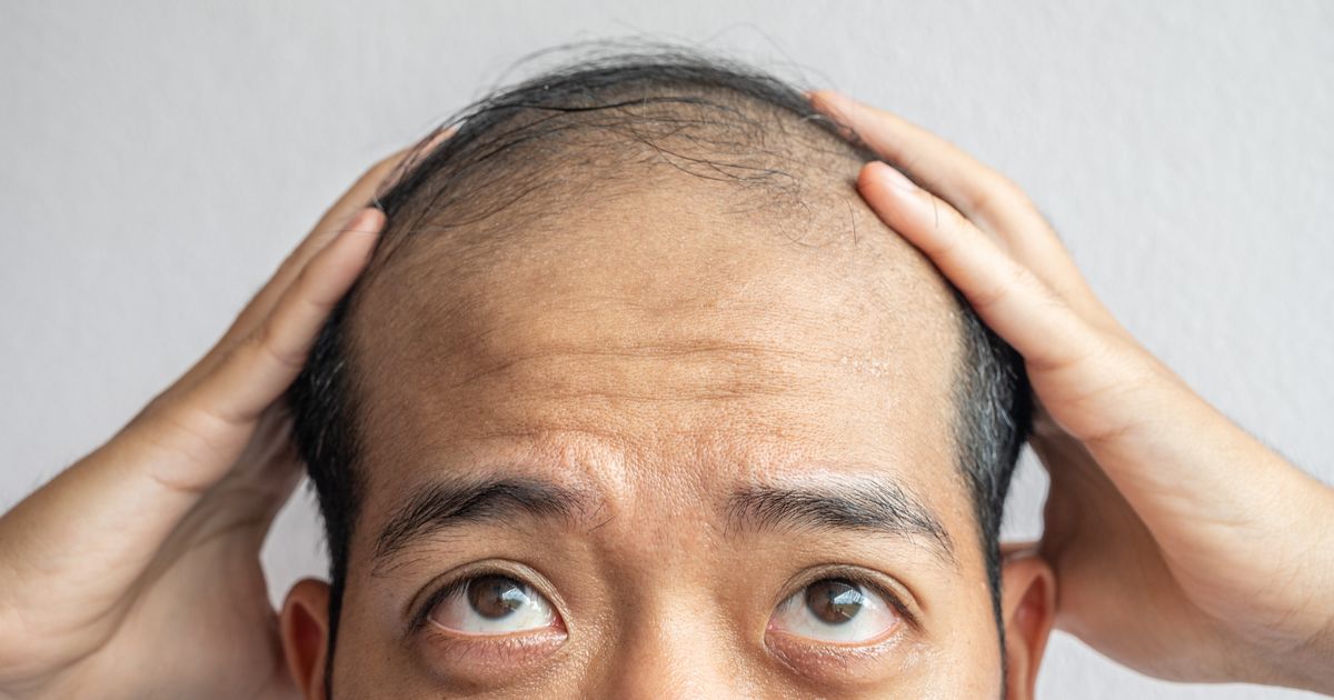 Uk Tribunal Rules Calling A Man Bald Is Sexual Harassment Huffpost Weird News 